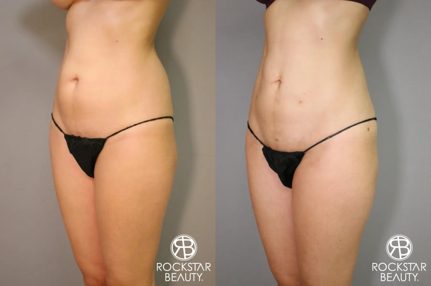 Liposuction: Patient 5 - Before and After 2