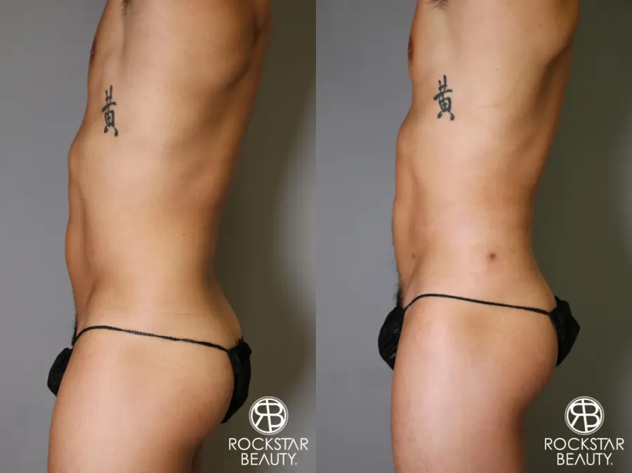 Liposuction: Patient 17 - Before and After 2