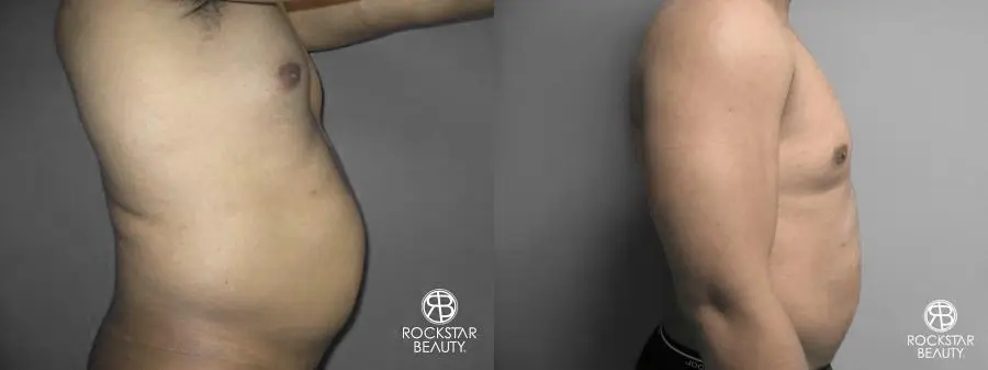 Liposuction: Patient 10 - Before and After 3