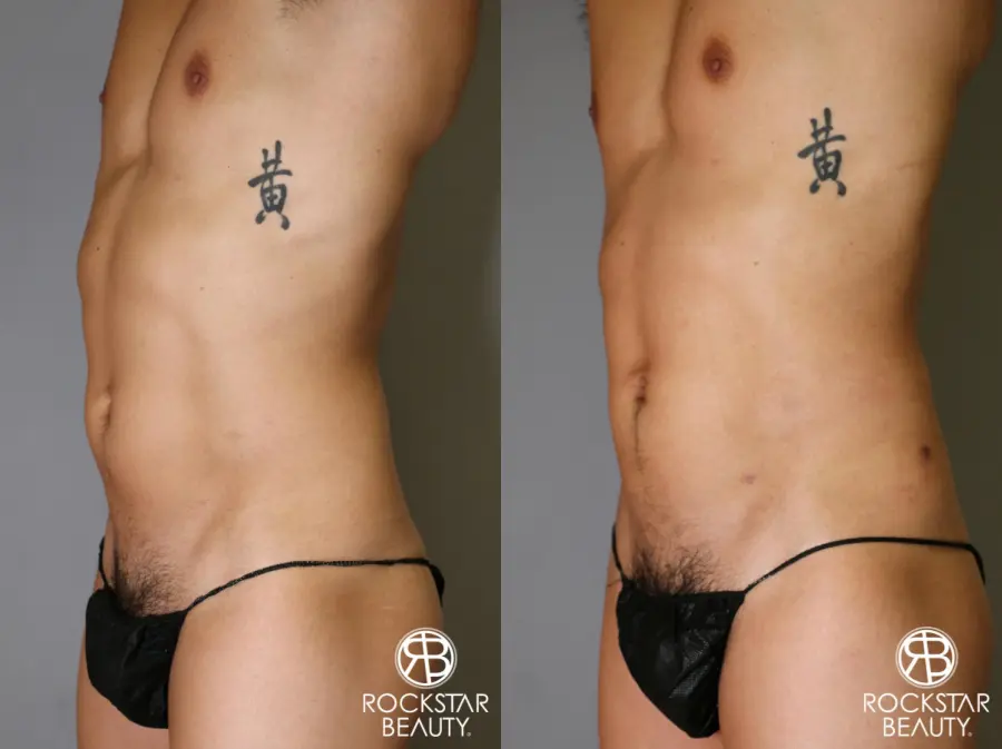 Liposuction: Patient 17 - Before and After 4