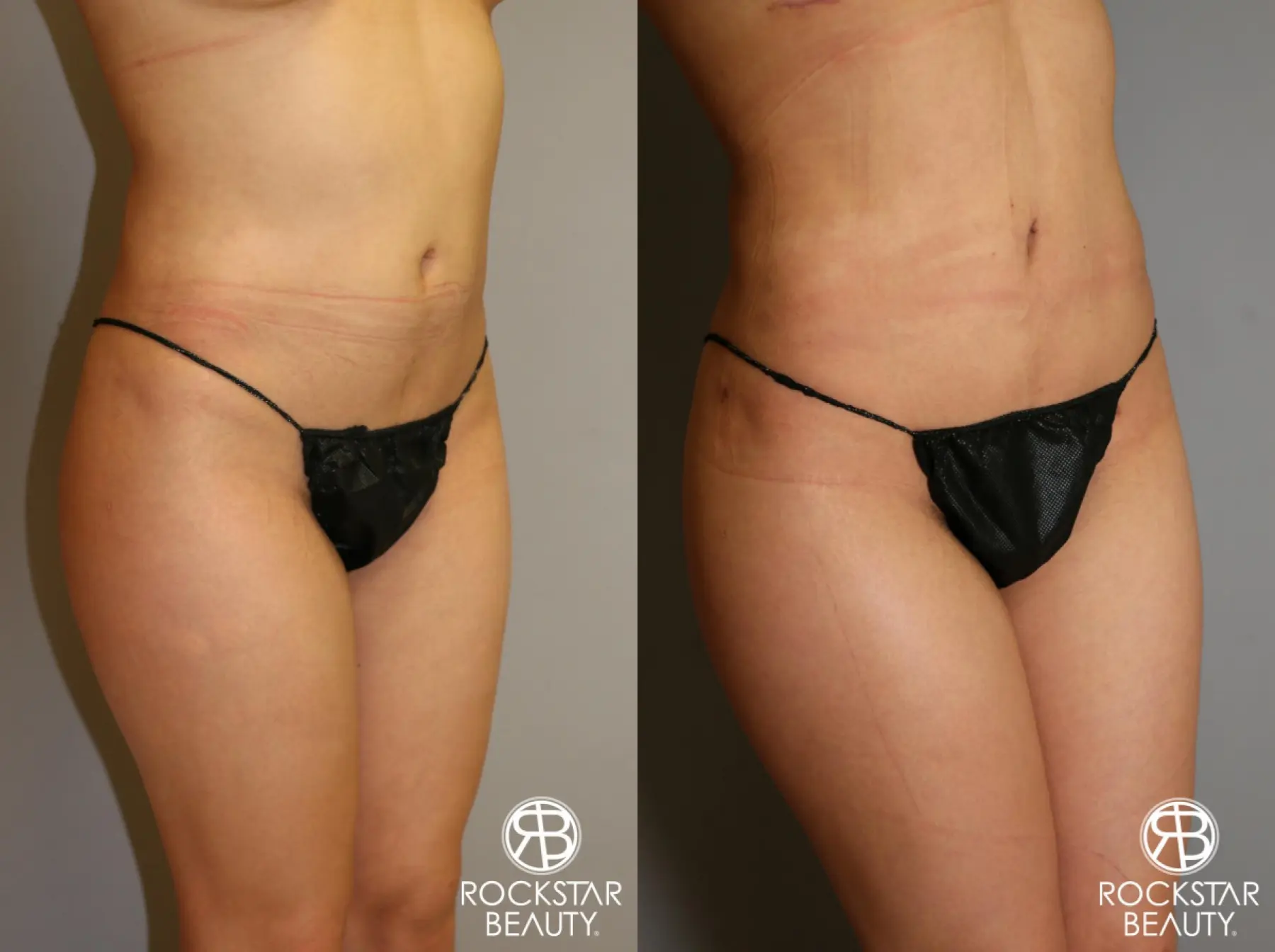 Liposuction: Patient 14 - Before and After 3