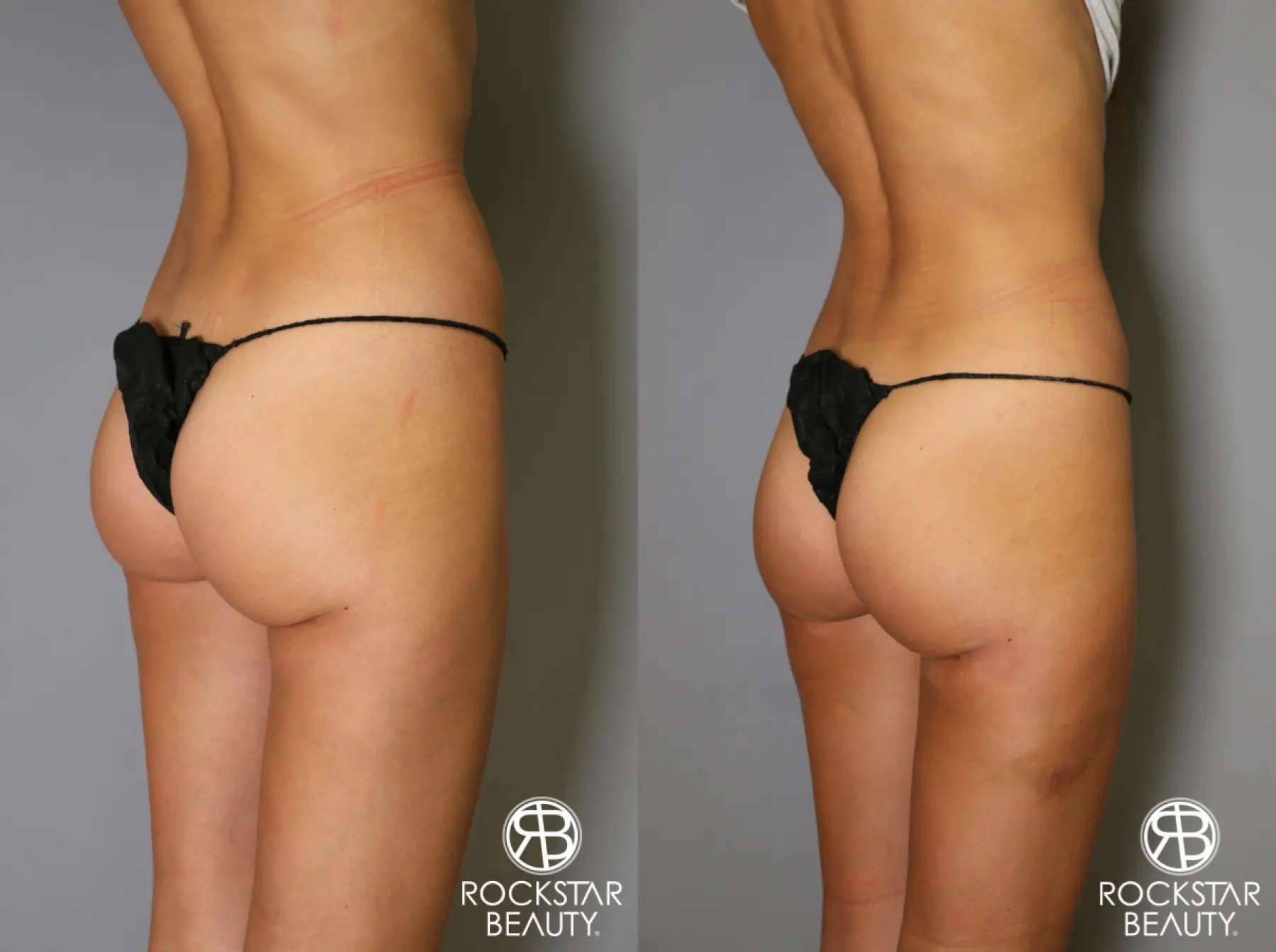 Liposuction: Patient 15 - Before and After 3