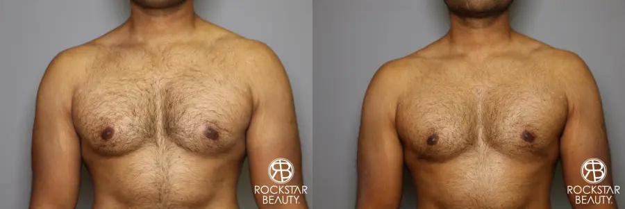 Liposuction: Patient 16 - Before and After 3