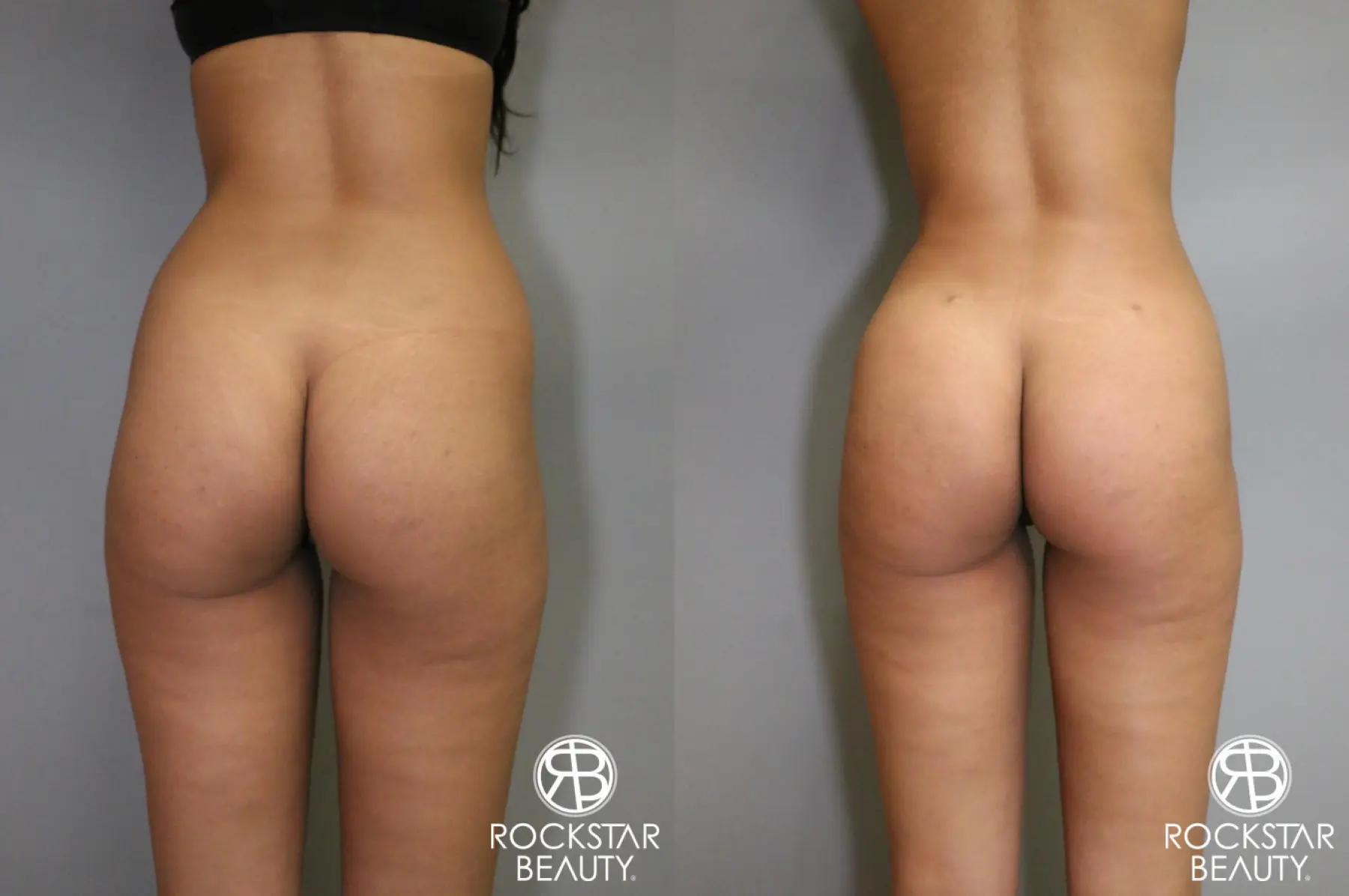 Liposuction: Patient 6 - Before and After  