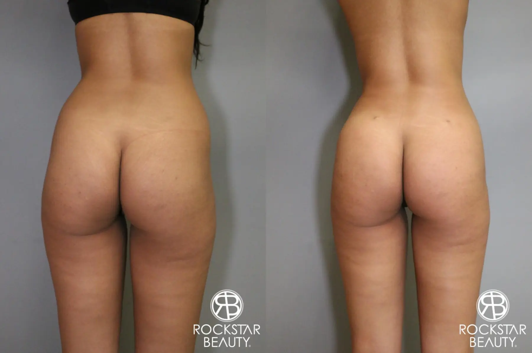 Liposuction: Patient 6 - Before and After 1