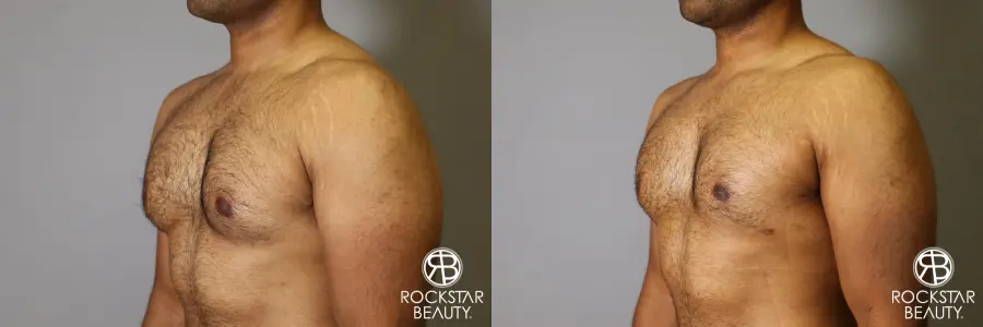 Liposuction: Patient 16 - Before and After 2