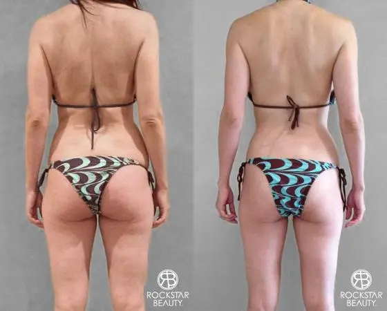 Liposuction: Patient 8 - Before and After 3