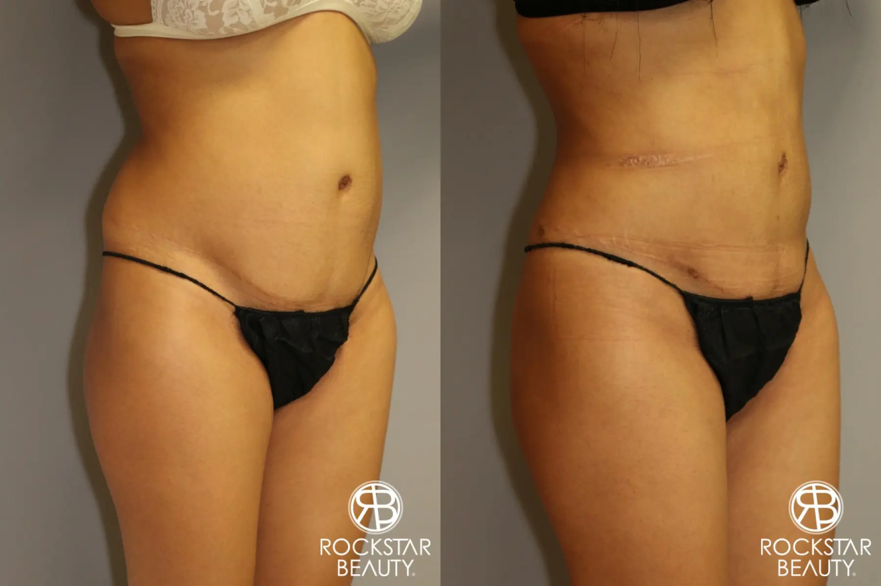 Liposuction: Patient 3 - Before and After 2