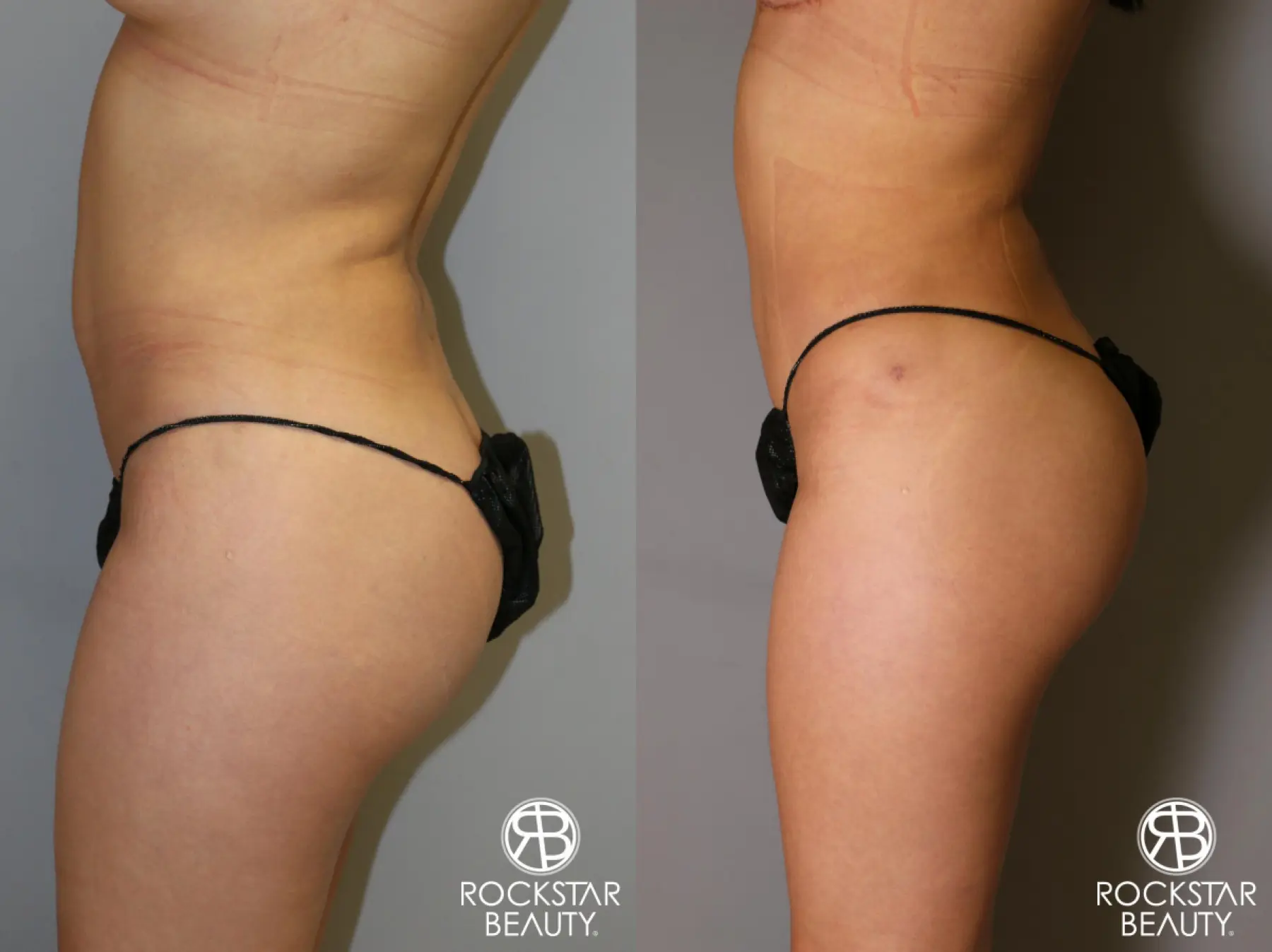 Liposuction: Patient 14 - Before and After 4