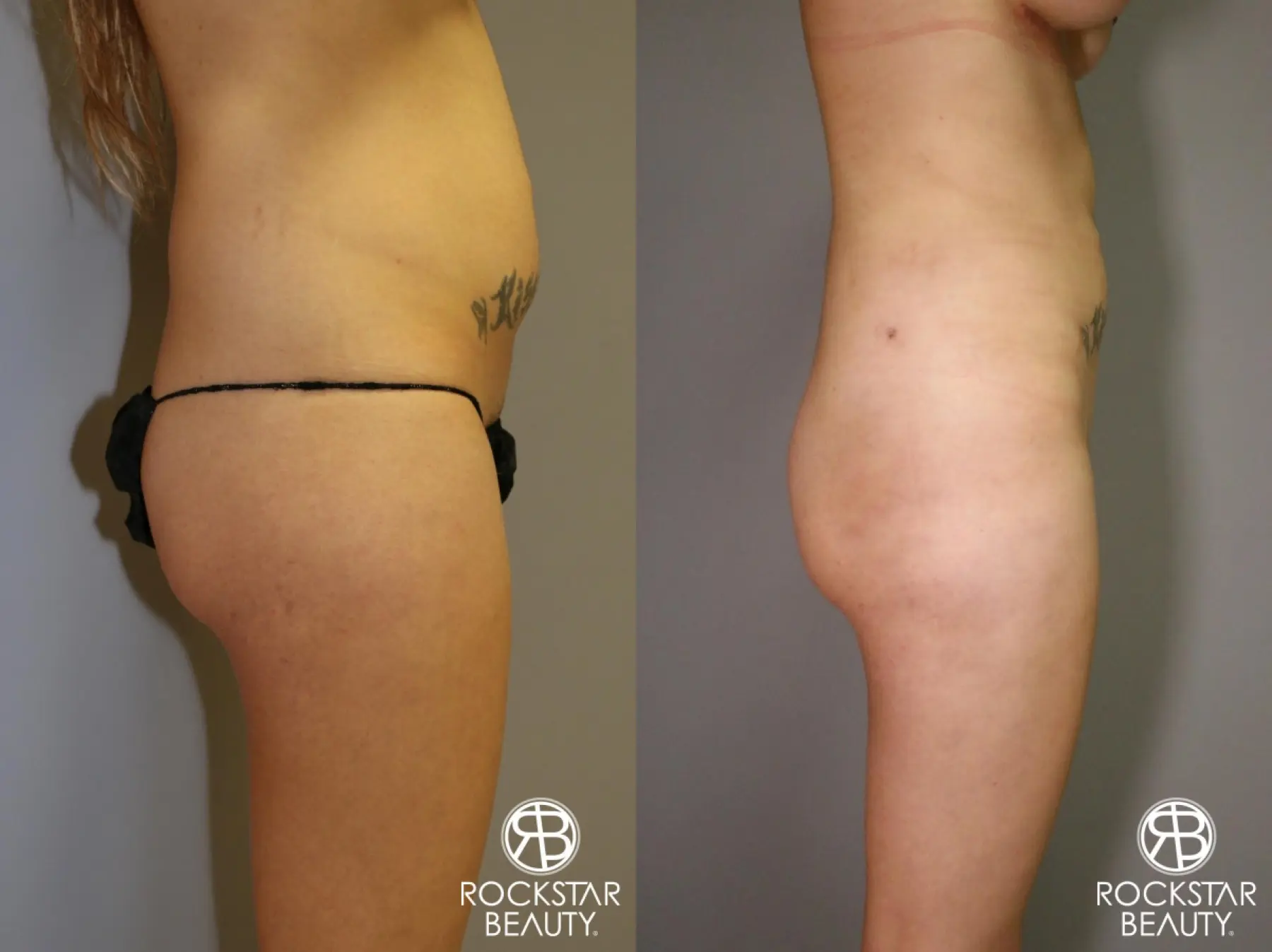 Liposuction: Patient 2 - Before and After 2