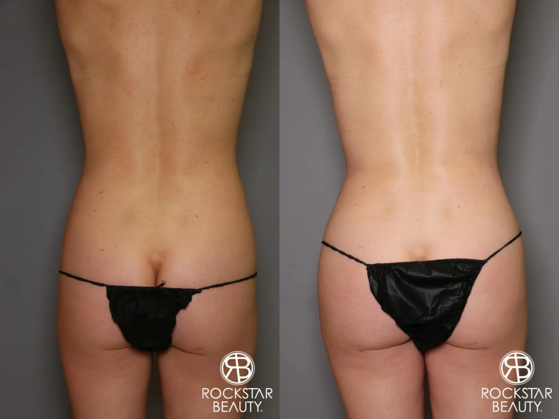 Liposuction: Patient 13 - Before and After 4