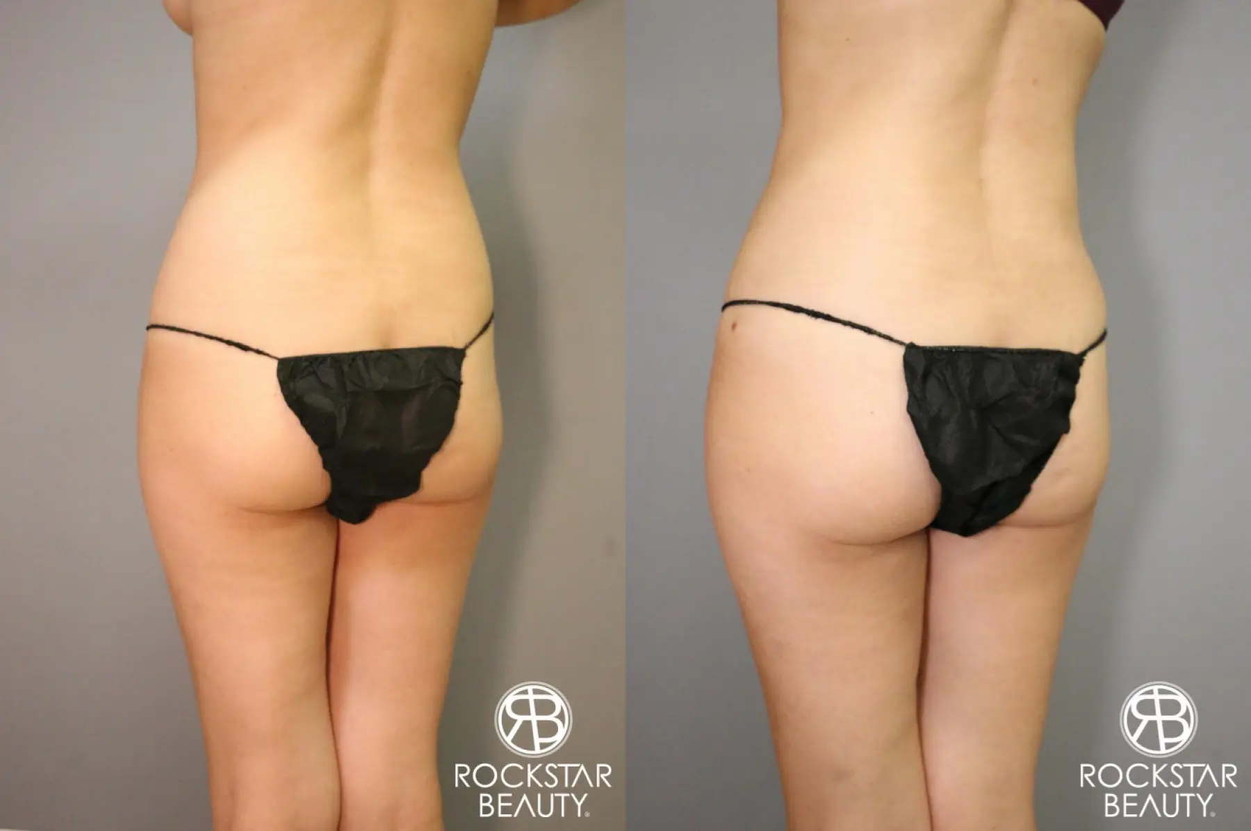 Liposuction: Patient 5 - Before and After 4