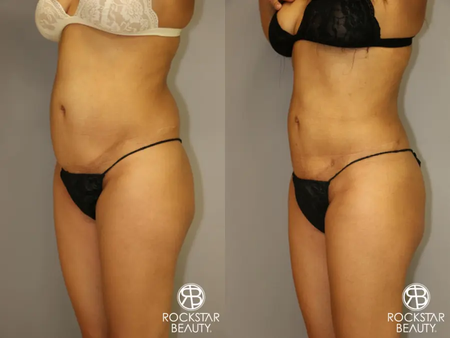 Liposuction: Patient 3 - Before and After 4