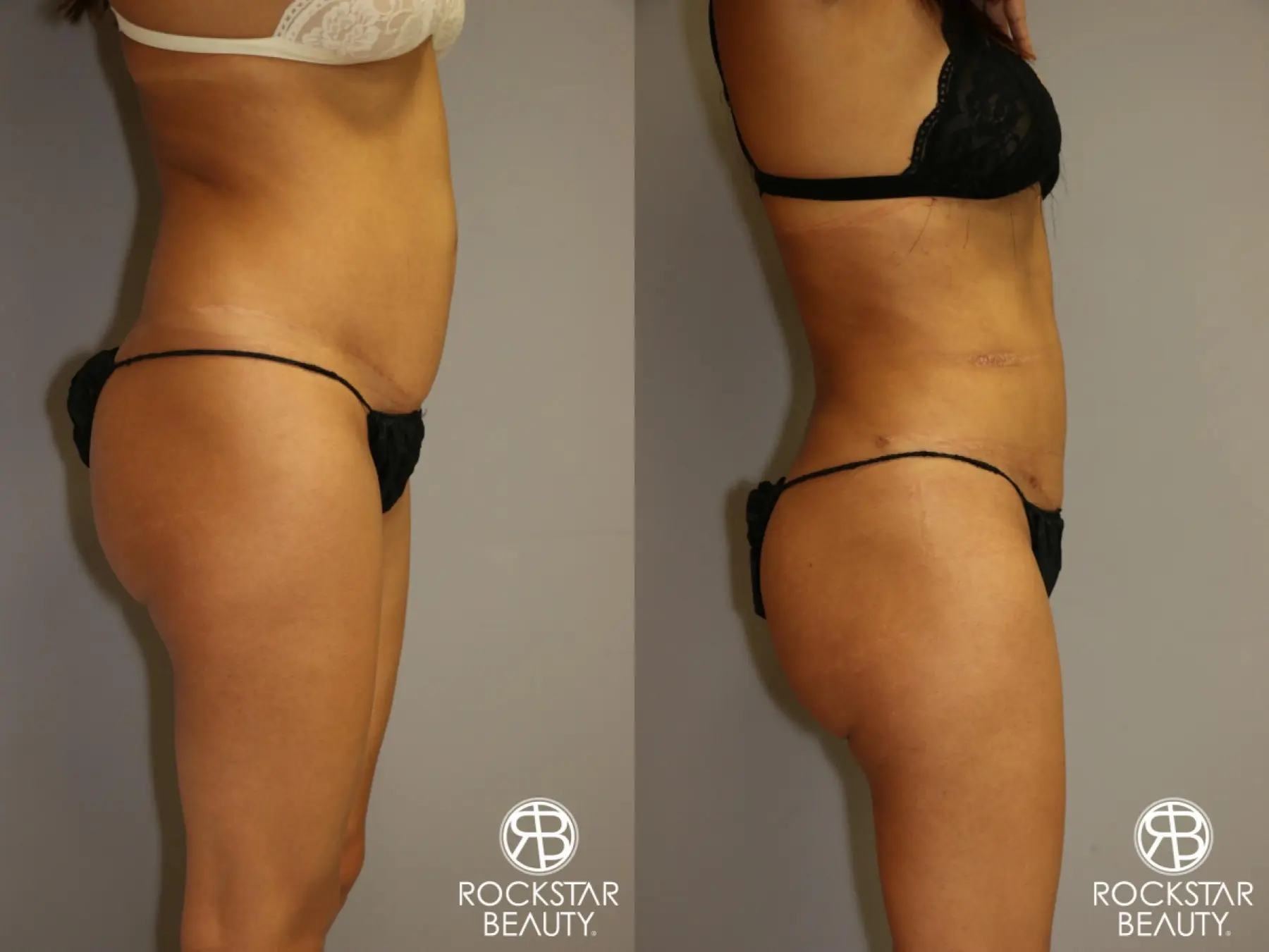 Liposuction: Patient 3 - Before and After 3