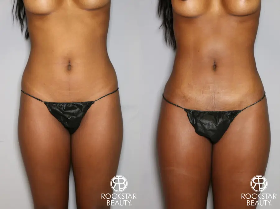 Liposuction: Patient 19 - Before and After 3