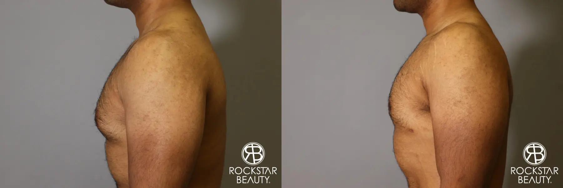 Liposuction: Patient 16 - Before and After 1