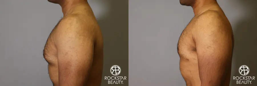Liposuction: Patient 16 - Before and After 1