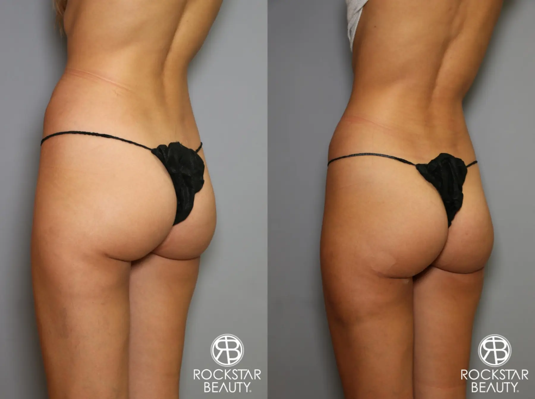 Liposuction: Patient 15 - Before and After 2