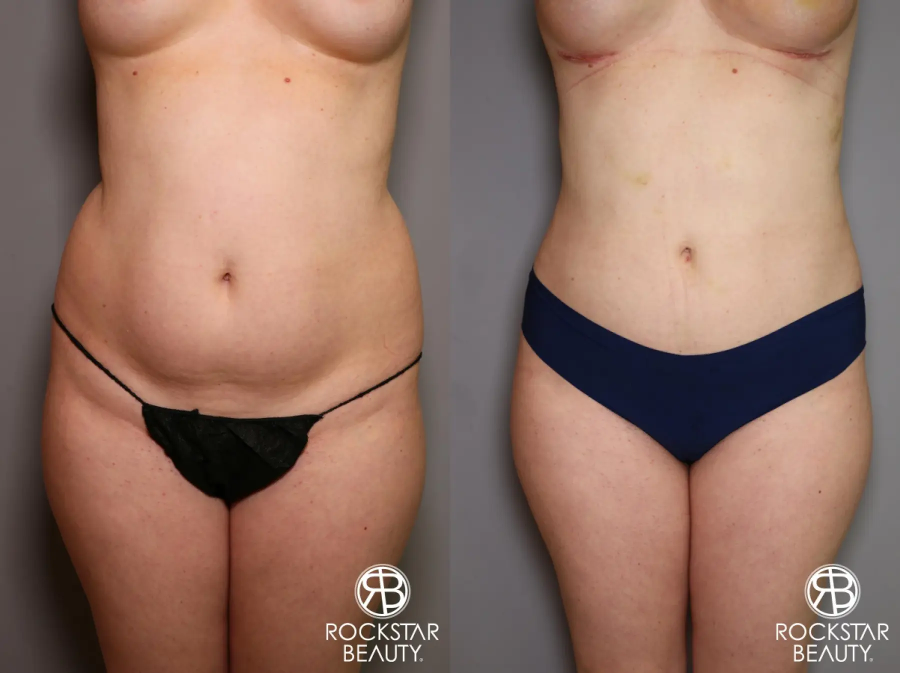 Liposuction: Patient 11 - Before and After 1