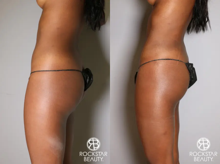 Liposuction: Patient 19 - Before and After 5