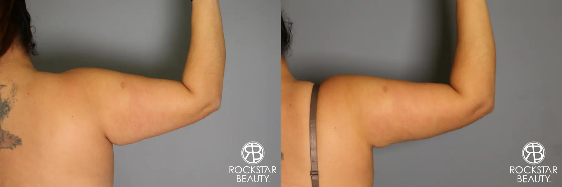 Liposuction: Patient 12 - Before and After 4