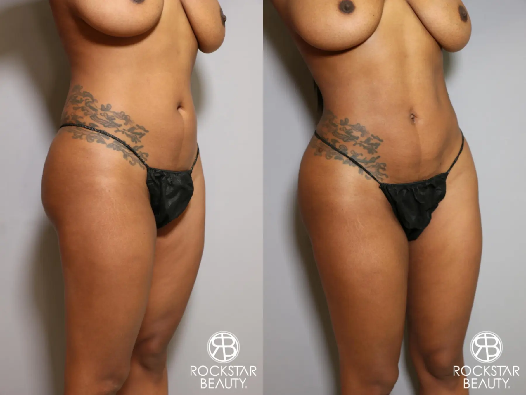 Liposuction: Patient 18 - Before and After 3