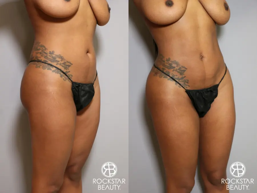 Liposuction: Patient 18 - Before and After 3