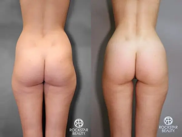 Liposuction: Patient 9 - Before and After  