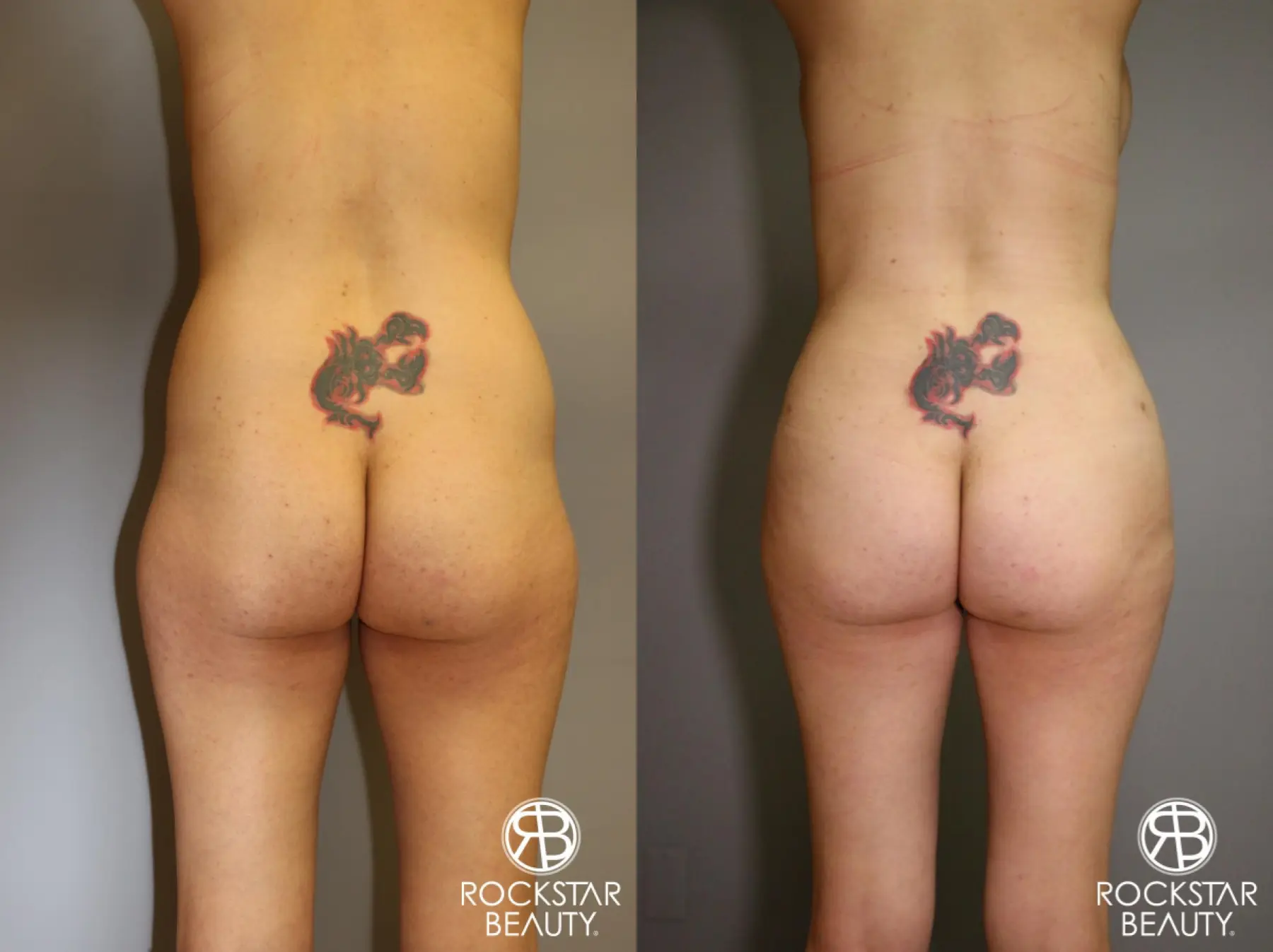 Liposuction: Patient 2 - Before and After 1