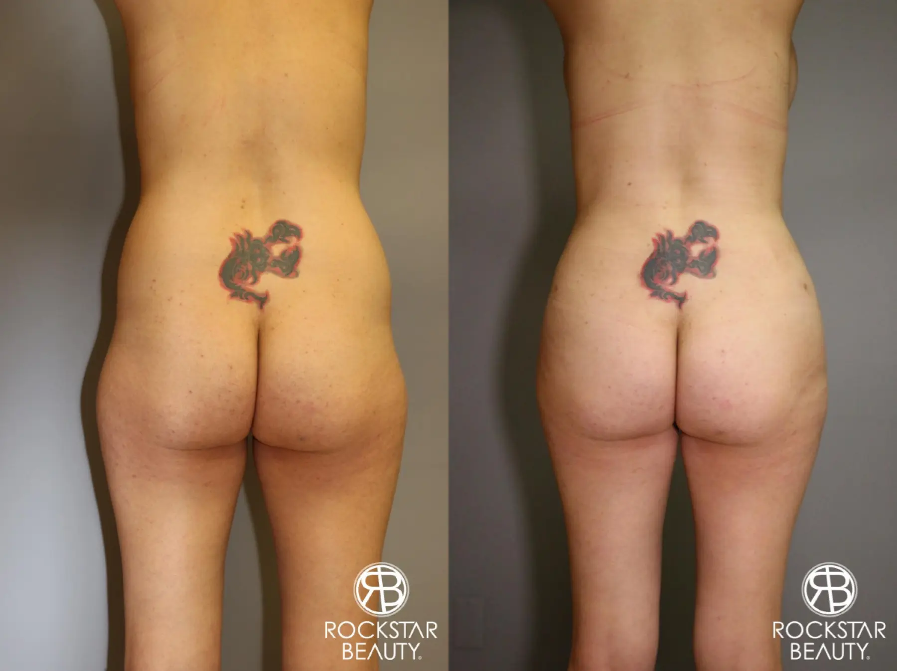 Liposuction: Patient 2 - Before and After  