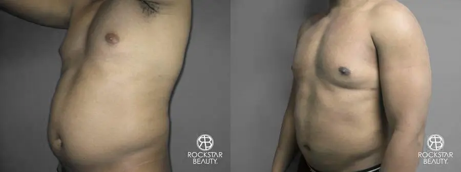 Liposuction: Patient 10 - Before and After 4