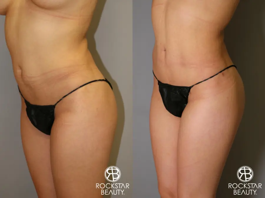 Liposuction: Patient 14 - Before and After 1