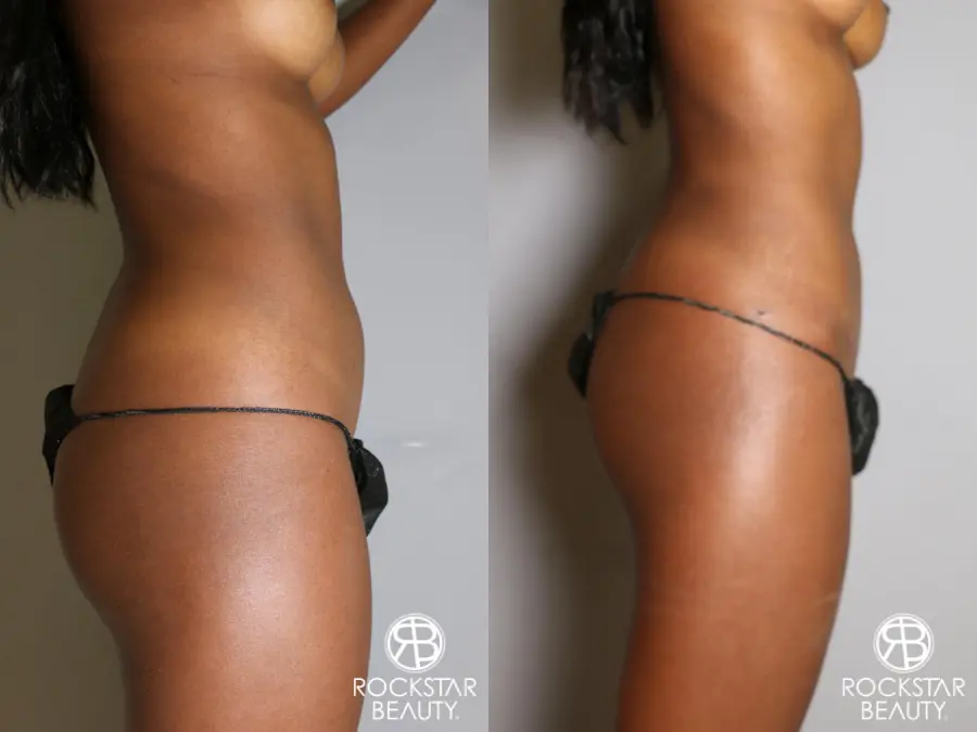 Liposuction: Patient 19 - Before and After 4
