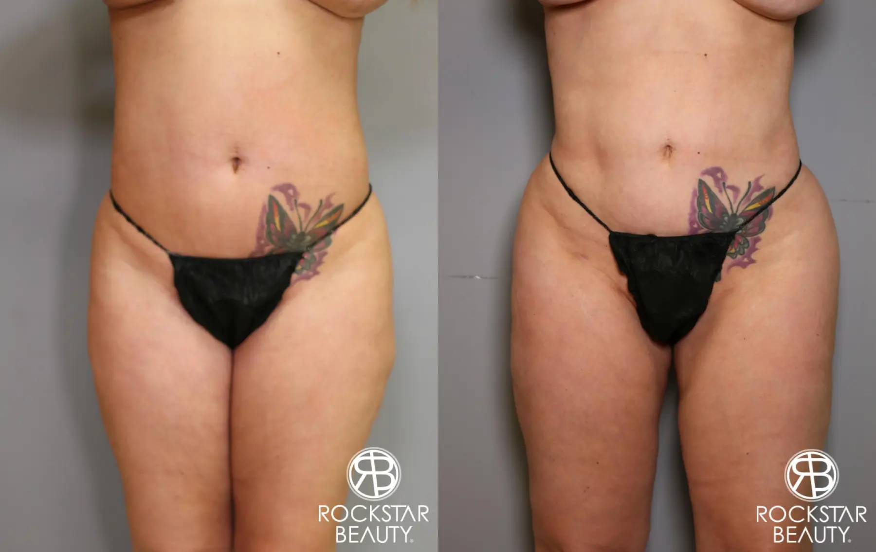 Liposuction: Patient 7 - Before and After  