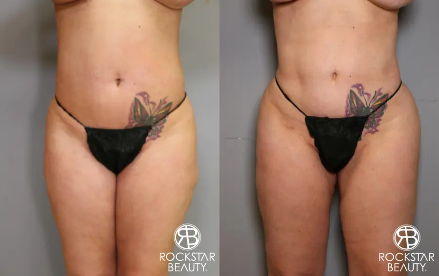 Liposuction: Patient 7 - Before and After 1