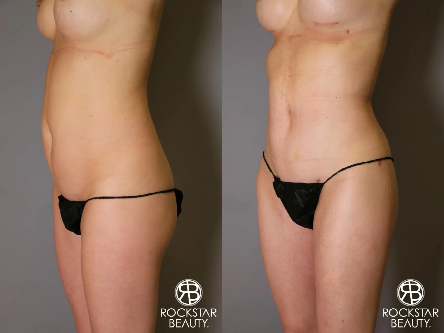 Liposuction: Patient 13 - Before and After 3