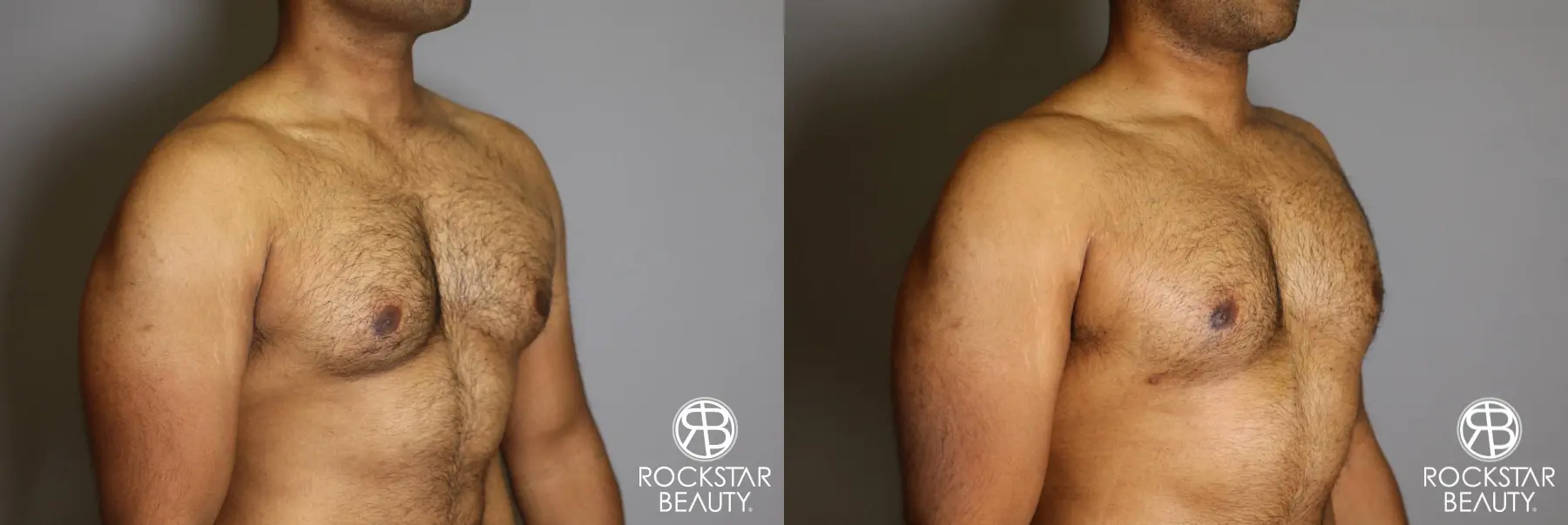 Liposuction: Patient 16 - Before and After 4