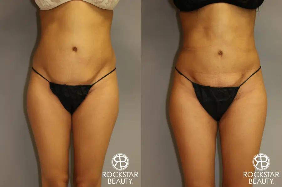 Liposuction: Patient 3 - Before and After  