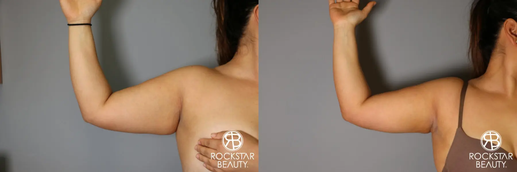 Liposuction: Patient 12 - Before and After 1