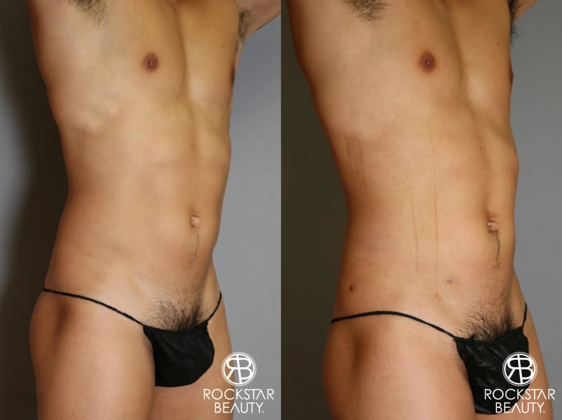 Liposuction: Patient 17 - Before and After 3