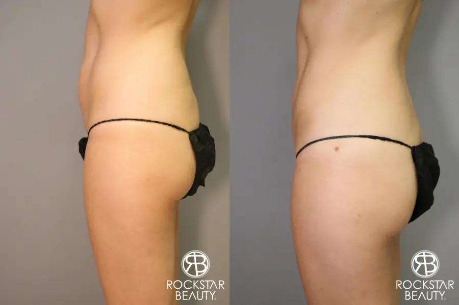 Liposuction: Patient 5 - Before and After 3