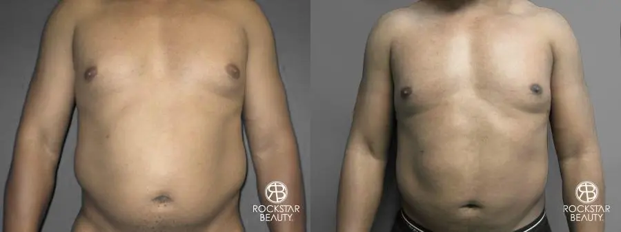 Liposuction: Patient 10 - Before and After 1