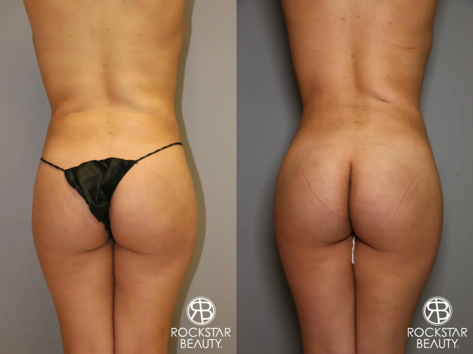 Liposuction: Patient 14 - Before and After 2