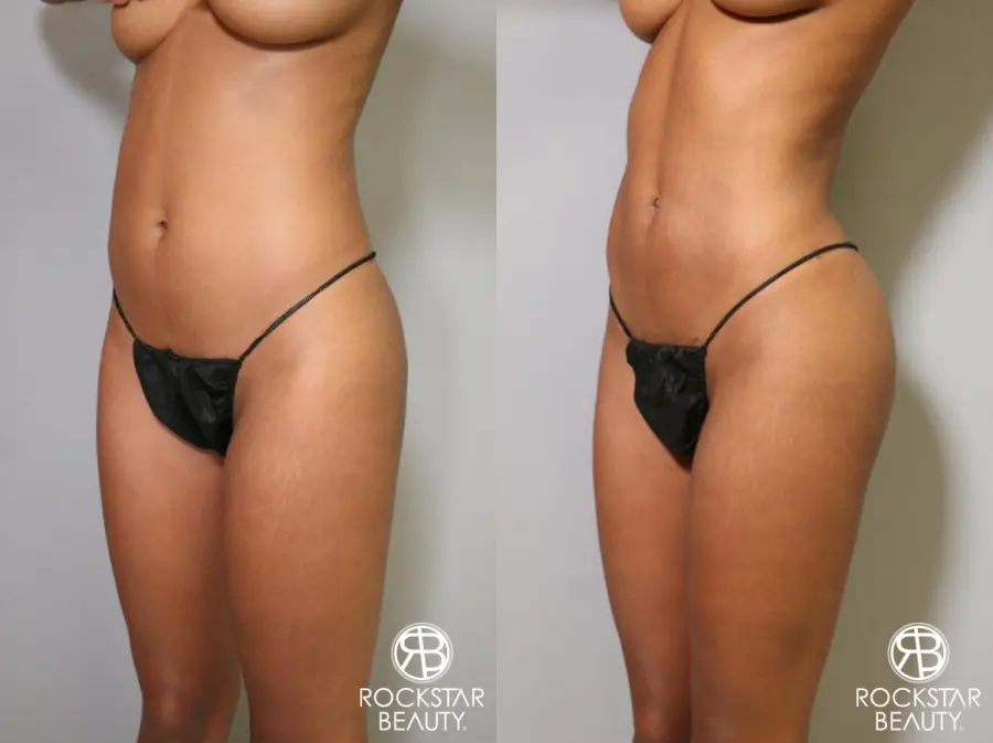 Liposuction: Patient 1 - Before and After 5