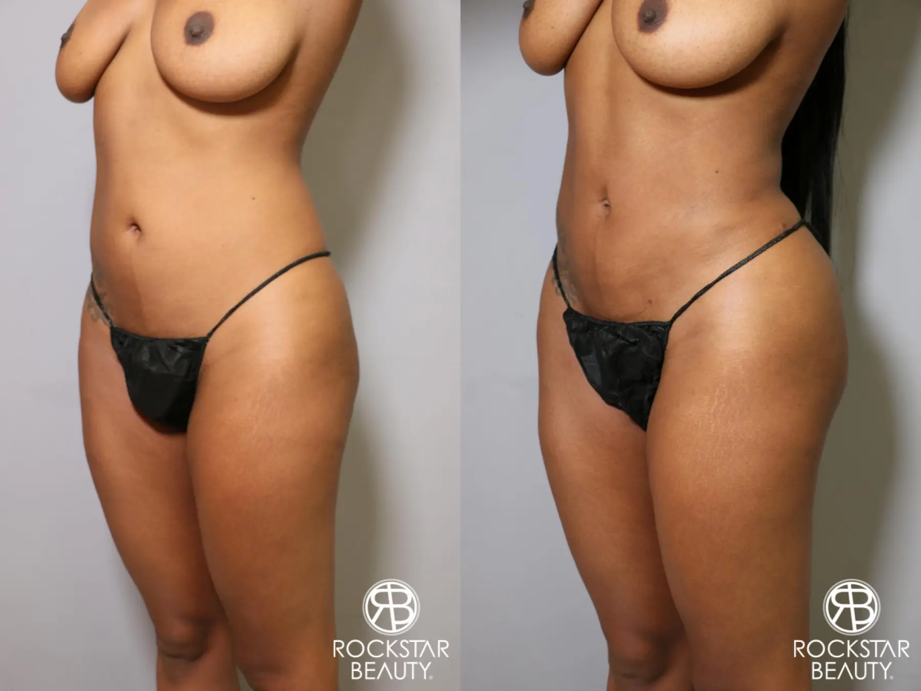 Liposuction: Patient 18 - Before and After 2