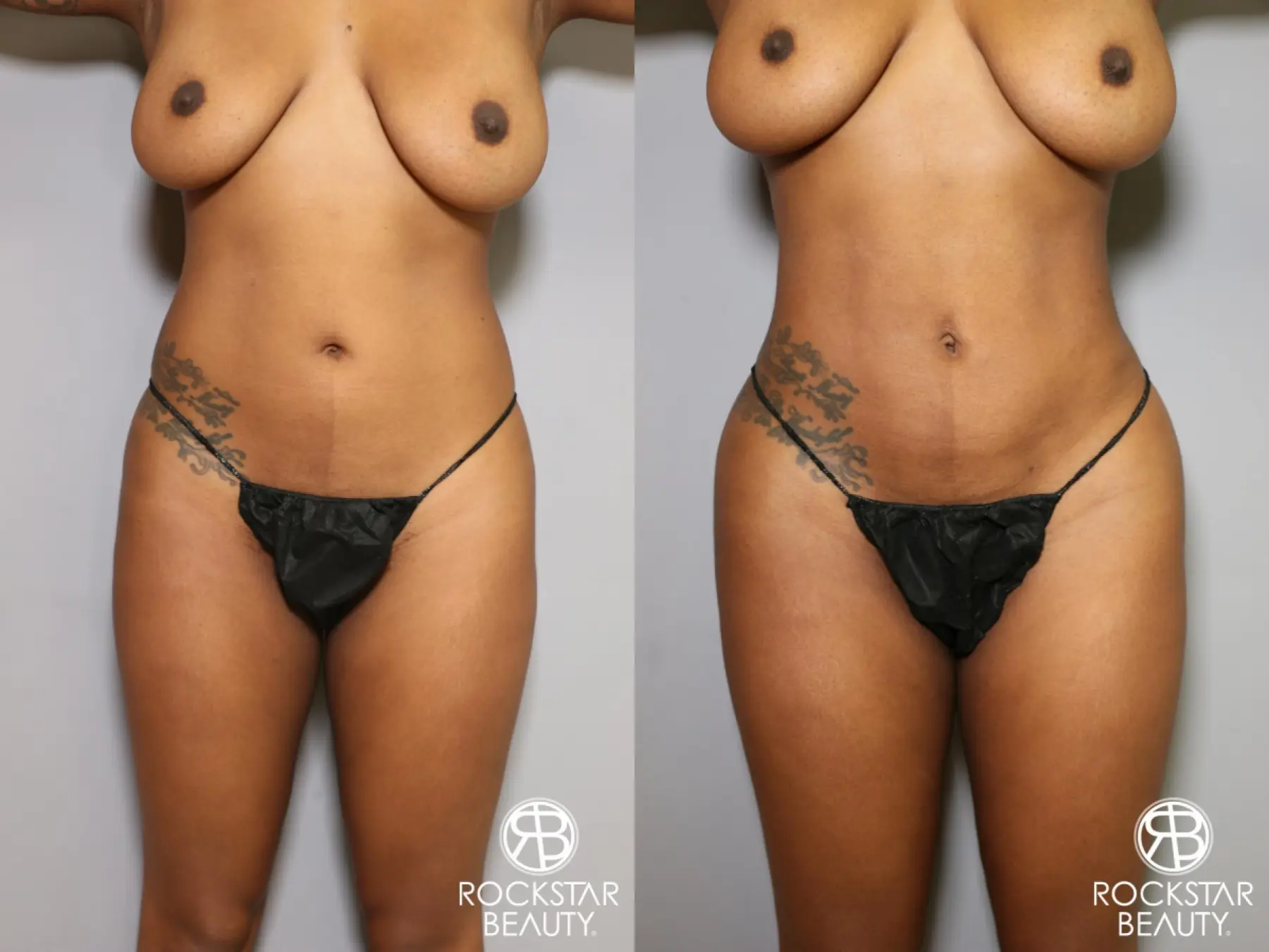 Liposuction: Patient 18 - Before and After 1