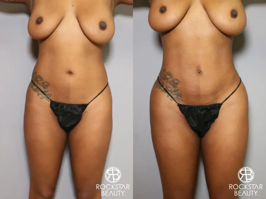 Liposuction: Patient 18 - Before and After 1