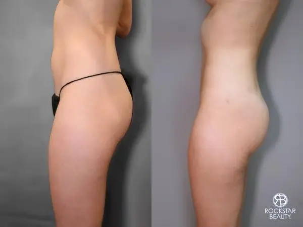 Liposuction: Patient 9 - Before and After 3