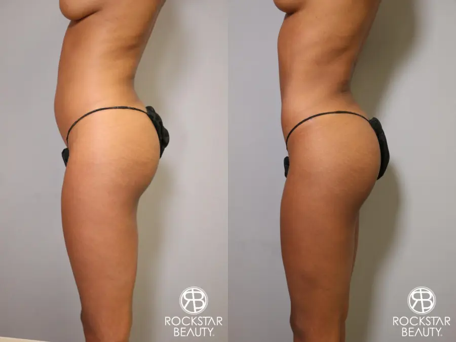 Liposuction: Patient 1 - Before and After 4