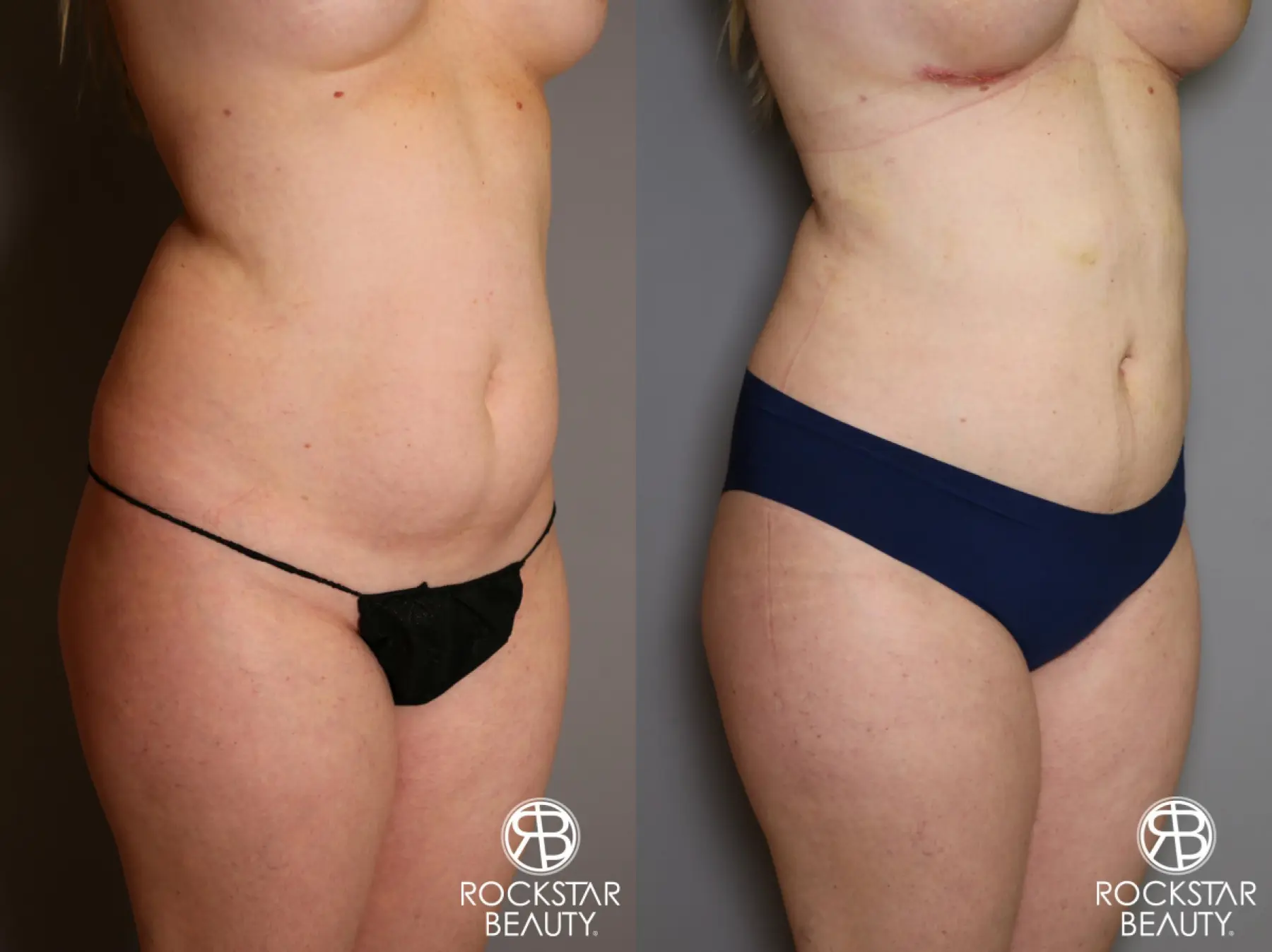 Liposuction: Patient 11 - Before and After 2